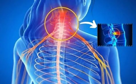 Thoát vị đĩa đệm đốt sống cổ là gì?